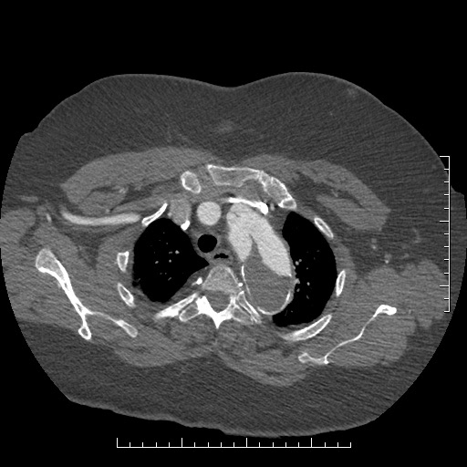 Aortic dissection- Stanford A (Radiopaedia 35729-37268 A 10).jpg