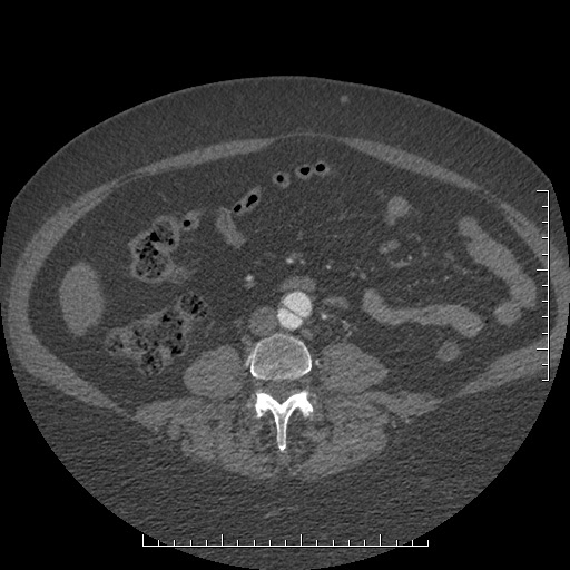 File:Aortic dissection- Stanford A (Radiopaedia 35729-37268 C 31).jpg