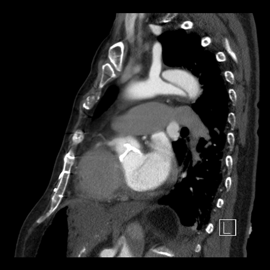 Aortic dissection (CTPA) (Radiopaedia 75506-86750 C 66).jpg