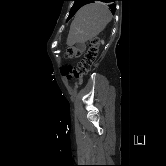 Aortic dissection (CTPA) (Radiopaedia 75506-86750 G 19).jpg