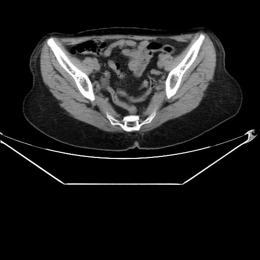 Aortic dissection (Radiopaedia 25350-25604 B 67).jpg