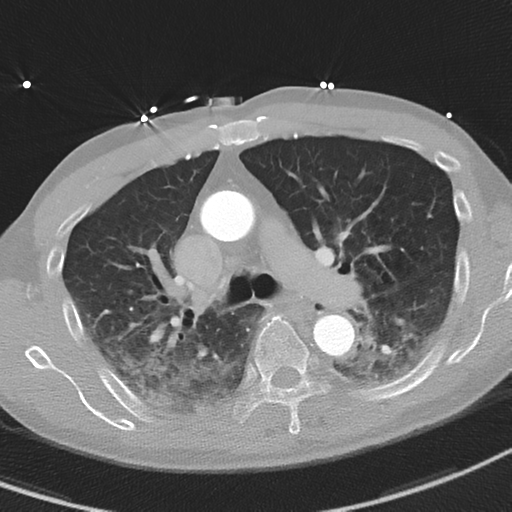 Aortic dissection - DeBakey type II (Radiopaedia 64302-73082 Axial lung window 24).png