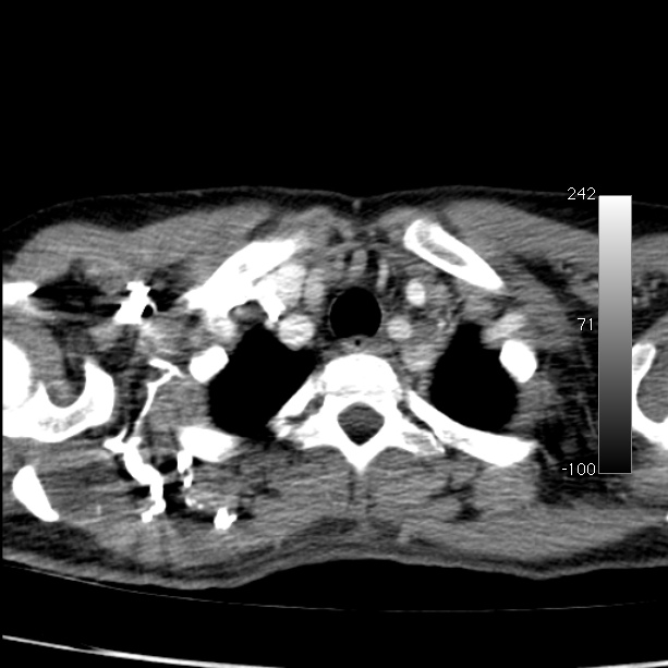 Aortic dissection - Stanford type A (Radiopaedia 29247-29659 A 10).jpg