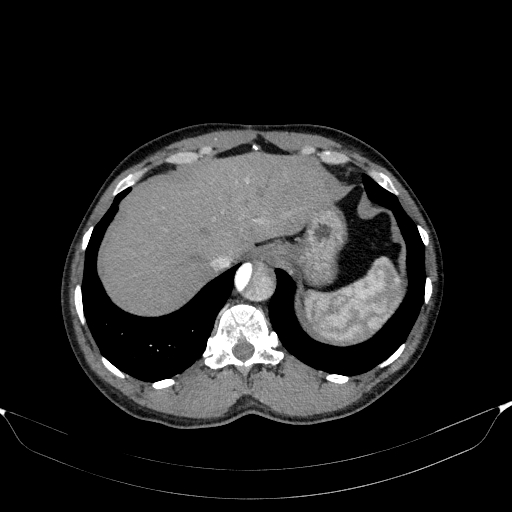 File:Aortic dissection - Stanford type A (Radiopaedia 83418-98500 A 56).jpg
