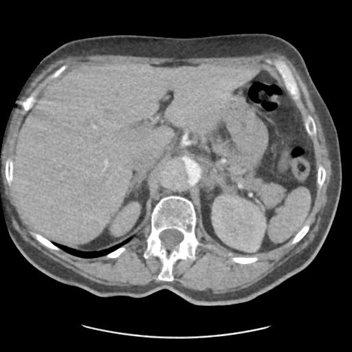 File:Aortic dissection - Stanford type B (Radiopaedia 50171-55512 A 49).png