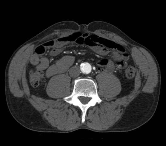 File:Aortic dissection - Stanford type B (Radiopaedia 73648-84437 A 188).jpg