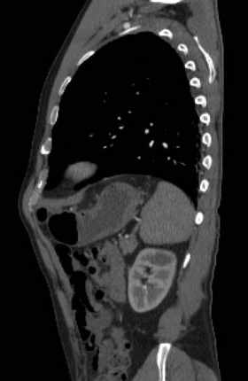 File:Aortic dissection - Stanford type B (Radiopaedia 73648-84437 C 34).jpg