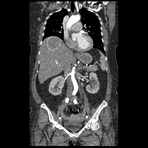 File:Aortic dissection - Stanford type B (Radiopaedia 88281-104910 B 32).jpg