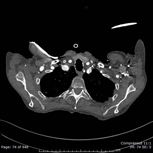 Aortic dissection with extension into aortic arch branches (Radiopaedia 64402-73204 B 74).jpg