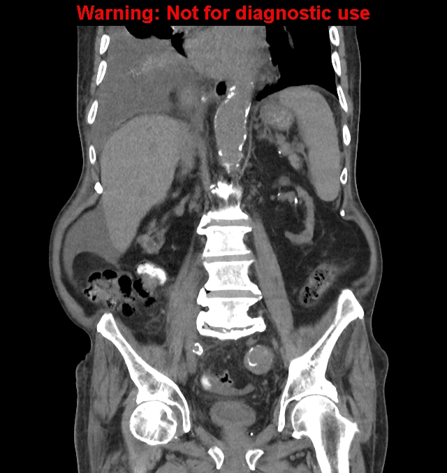 Aortic graft infection (Radiopaedia 44979-48907 non-contrast 30).jpg