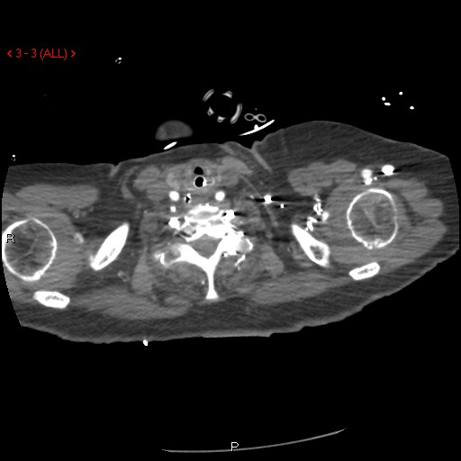 Aortic intramural hematoma (Radiopaedia 27746-28001 A 3).jpg