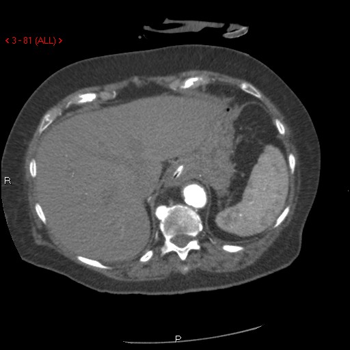 Aortic intramural hematoma (Radiopaedia 27746-28001 A 81).jpg