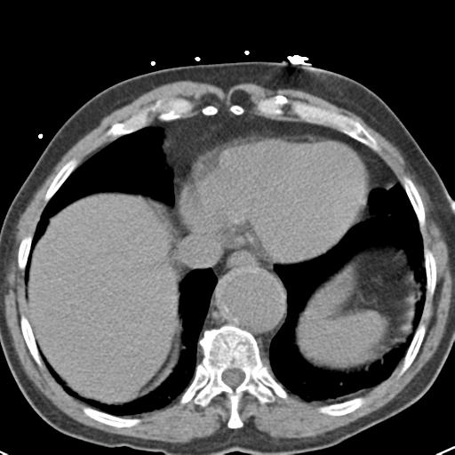 File:Aortic intramural hematoma (Radiopaedia 31139-31838 Axial non-contrast 42).jpg