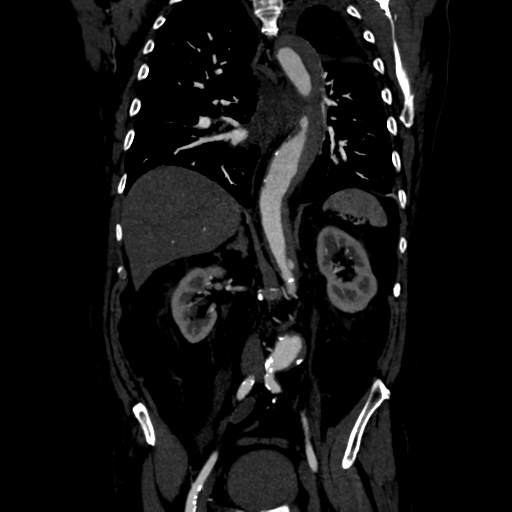 Aortic intramural hematoma (Radiopaedia 34260-35540 C 54).png