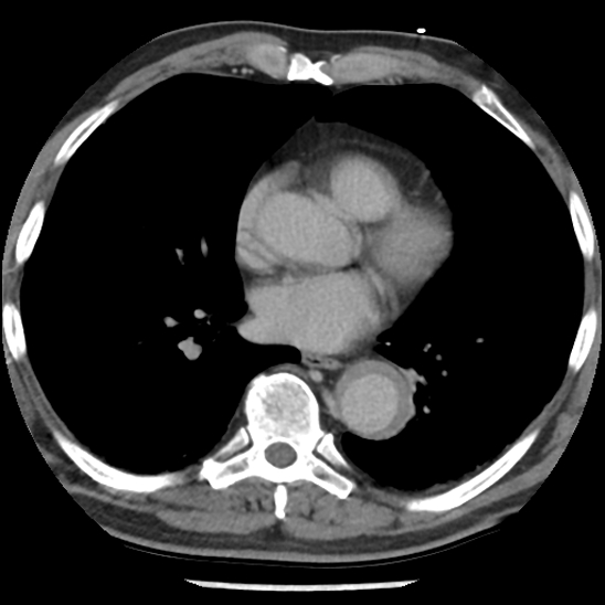 Aortic intramural hematoma (type B) (Radiopaedia 79323-92387 Axial C+ delayed 31).jpg
