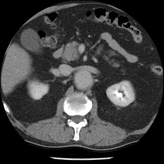 File:Aortic intramural hematoma (type B) (Radiopaedia 79323-92387 Axial C+ delayed 64).jpg