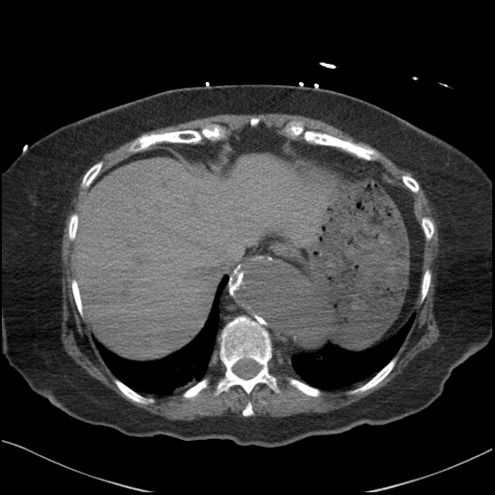 Aortic intramural hematoma with dissection and intramural blood pool (Radiopaedia 77373-89491 Axial non-contrast 83).jpg