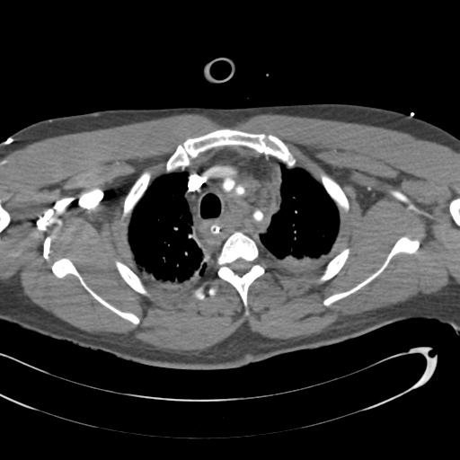 Aortic transection, diaphragmatic rupture and hemoperitoneum in a complex multitrauma patient (Radiopaedia 31701-32622 A 22).jpg