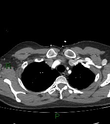 File:Aortic valve endocarditis (Radiopaedia 87209-103485 C 16).jpg