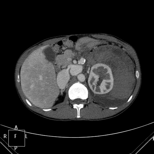 File:Aorto-left renal vein fistula (Radiopaedia 45534-49628 A 14).jpg