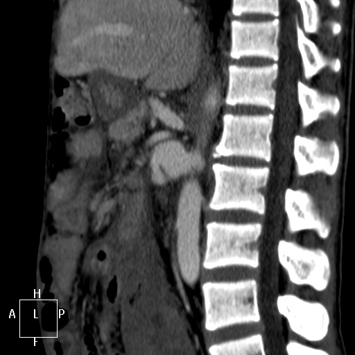 Aorto-left renal vein fistula (Radiopaedia 45534-49628 C 33).jpg