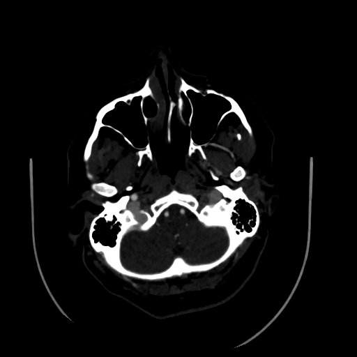 Aplasia of the internal carotid artery (Radiopaedia 61082-68960 A 11).jpg