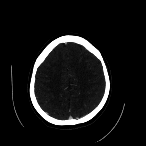 File:Aplasia of the internal carotid artery (Radiopaedia 61082-68960 A 52).jpg