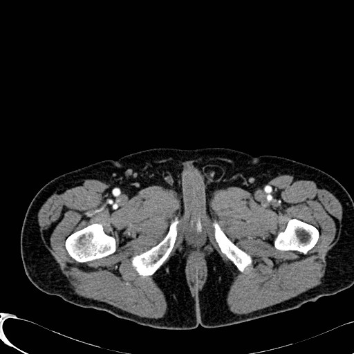 File:Appendiceal adenocarcinoma complicated by retroperitoneal abscess (Radiopaedia 58007-65039 B 158).jpg