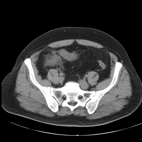 File:Appendicitis and giant appendicolith (Radiopaedia 80251-93588 Axial non-contrast 44).jpg