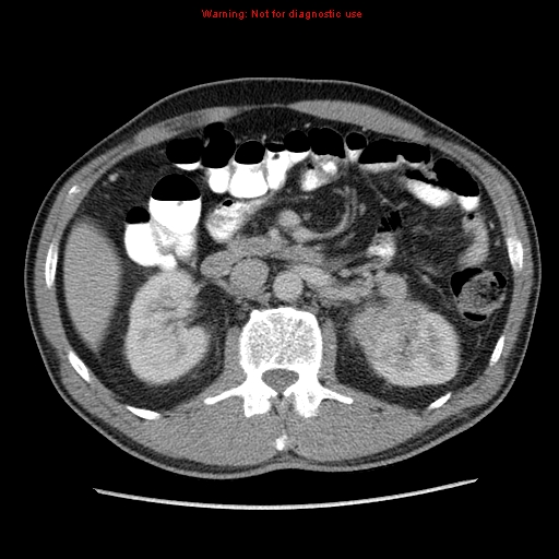 File:Appendicitis and renal cell carcinoma (Radiopaedia 17063-16760 A 22).jpg