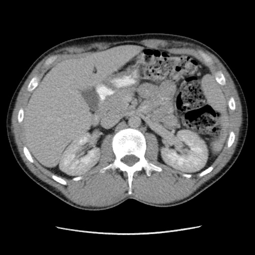 Appendicitis complicated by post-operative collection (Radiopaedia 35595-37113 A 23).jpg