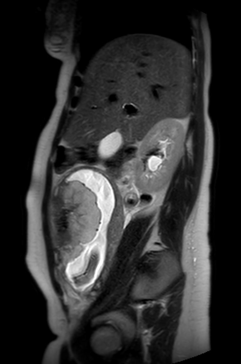 Appendicitis in gravida (MRI) (Radiopaedia 89433-106395 Sagittal T2 45).jpg