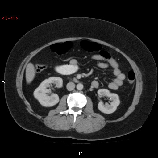 File:Appendicitis with microperforation- promontoric type (Radiopaedia 27268-27442 C 29).jpg