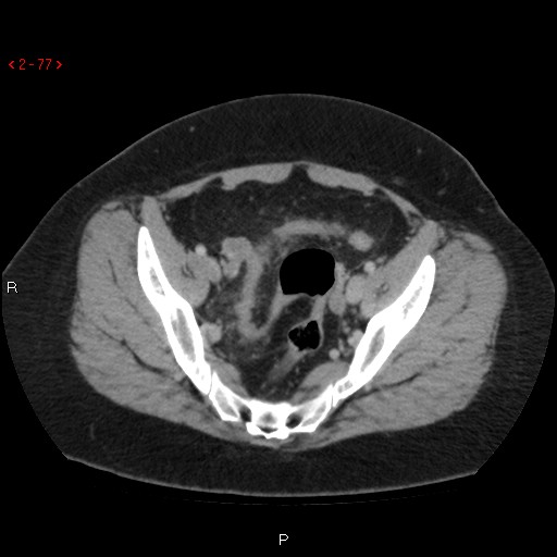Appendicitis with microperforation- promontoric type (Radiopaedia 27268-27442 C 65).jpg