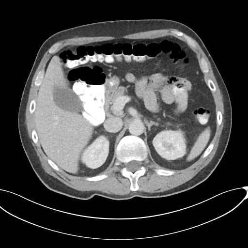 Appendicitis with thickening of the terminal ileum (Radiopaedia 42432-45550 A 31).png