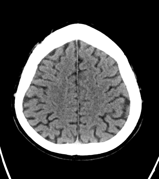 File:Aqueduct stenosis with corpus callosum hypoattenuation post shunting (Radiopaedia 37212-38971 Axial non-contrast 23).png