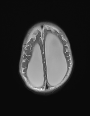 File:Aqueductal stenosis (Radiopaedia 73974-84802 Axial T2 18).jpg