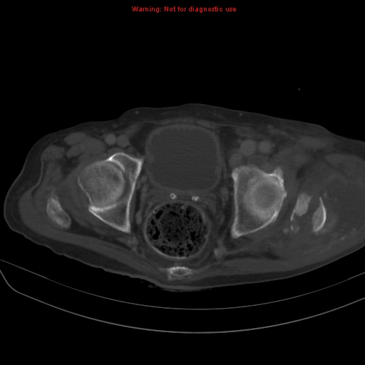 File:Arachnoiditis ossificans (Radiopaedia 51394-57136 Axial bone window 42).jpg