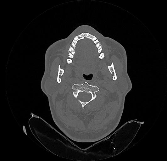 Arcuate foramen (Radiopaedia 89833-106944 Axial bone window 55).jpg