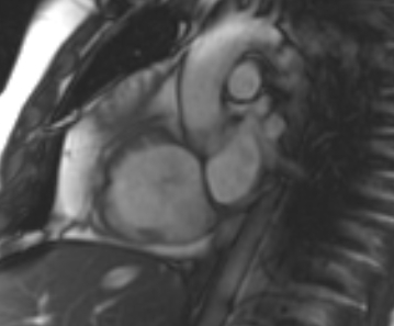 Arrhythmogenic right ventricular cardiomyopathy (Radiopaedia 69431-79307 Short axis cine 226).jpg