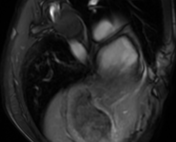 Arrhythmogenic right ventricular cardiomyopathy (Radiopaedia 69564-79464 4ch cine 149).jpg
