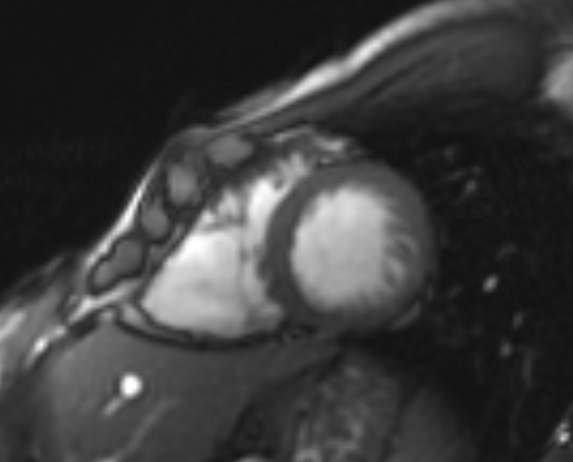 File:Arrhythmogenic right ventricular cardiomyopathy (Radiopaedia 69564-79464 short axis cine 82).jpg