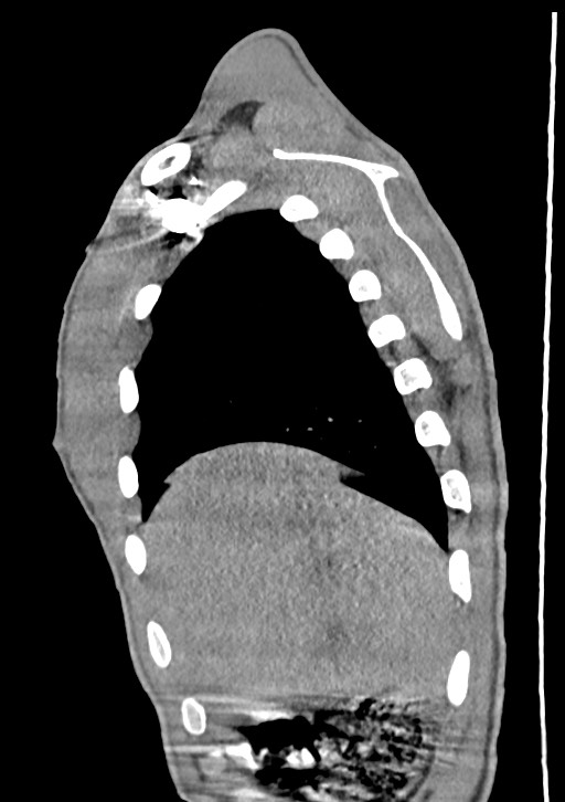 Arrow injury in the neck (Radiopaedia 75268-86390 G 44).jpg