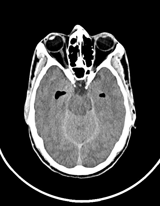 Arrow injury to the brain (Radiopaedia 72101-82607 Axial non-contrast 64).jpg