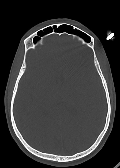 Arrow injury to the head (Radiopaedia 75266-86388 Axial bone window 76).jpg