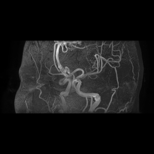 Arteriovenous malformation (Radiopaedia 71628-81999 Axial MRA 7).jpg