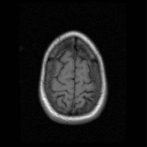File:Arteriovenous malformation (cerebral) (Radiopaedia 40070-42580 Axial T1 20).png