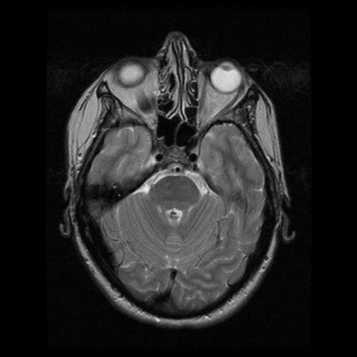 File:Arteriovenous malformation (cerebral) (Radiopaedia 40070-42580 Axial T2 8).png