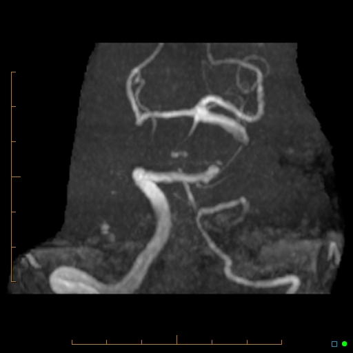 File:Artifactual basilar artery stenosis due to metallic stent (Radiopaedia 31206-31922 3D MIP 2).jpg