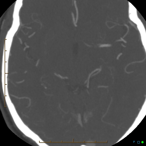 File:Artifactual basilar artery stenosis due to metallic stent (Radiopaedia 31206-31923 A 21).jpg